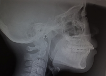 セファロ分析による精密な矯正診断