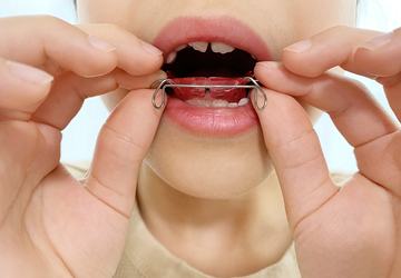 矯正装置の装着・治療開始